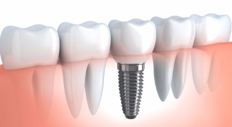 Dental Implants, Richmond Hill Oral Surgery 